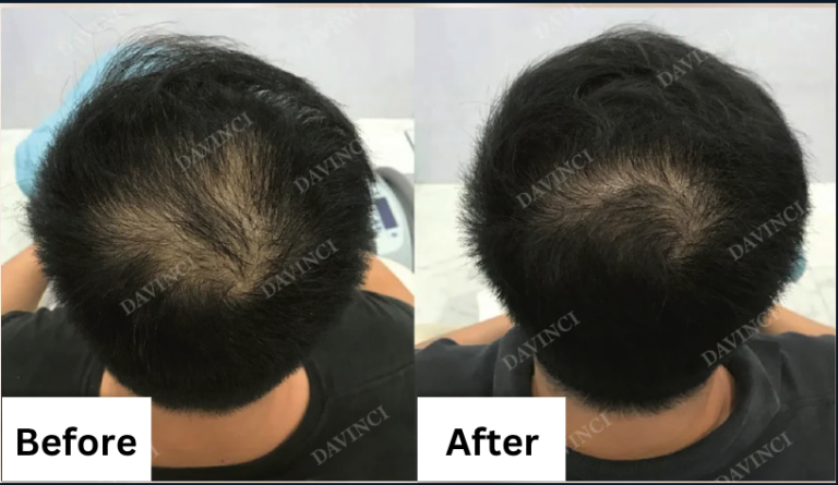 DV Hair Loss Before & After 3